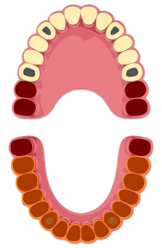 12 Elementi dentari su 4 Impianti in arcata superiore. 2 Impianti in arcata inferiore con attacchi sferici per la Protesi Rimovibile
